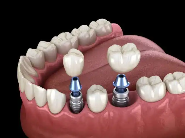 implant