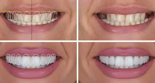 طراحی لبخند چیست