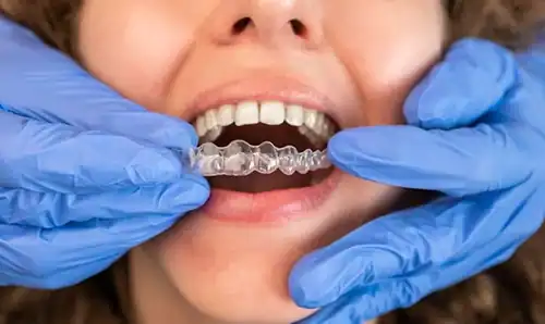 Invisible orthodontics11