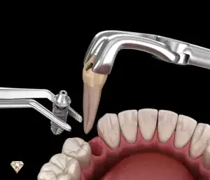 ایمپلنت فوری چیست؟ مزایا، معایب و هزینه