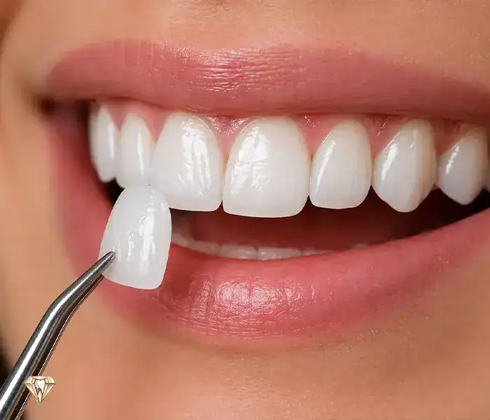 لمینت سرامیکی دندان در هروی