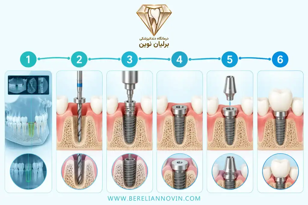 مراحل کاشت ایمپلنت دندان