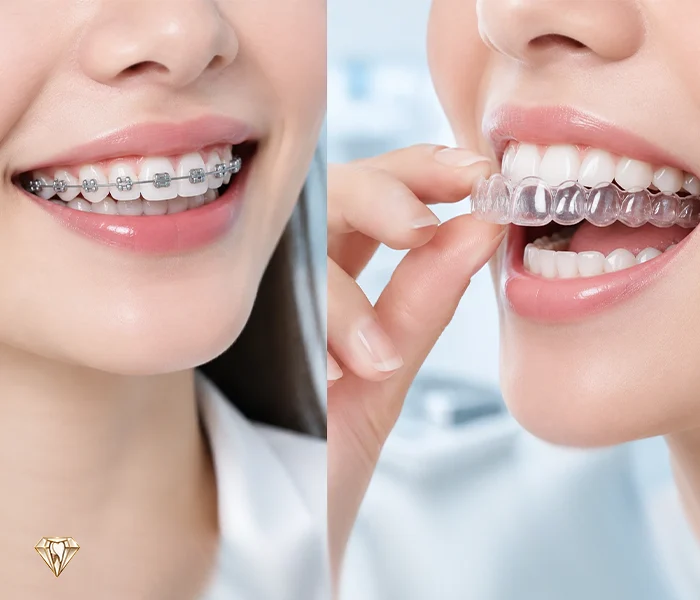 ارتودنسی ثابت بهتر است یا متحرک