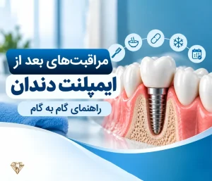 مراقبت‌های بعد از ایمپلنت دندان؛ راهنمای گام‌به‌گام